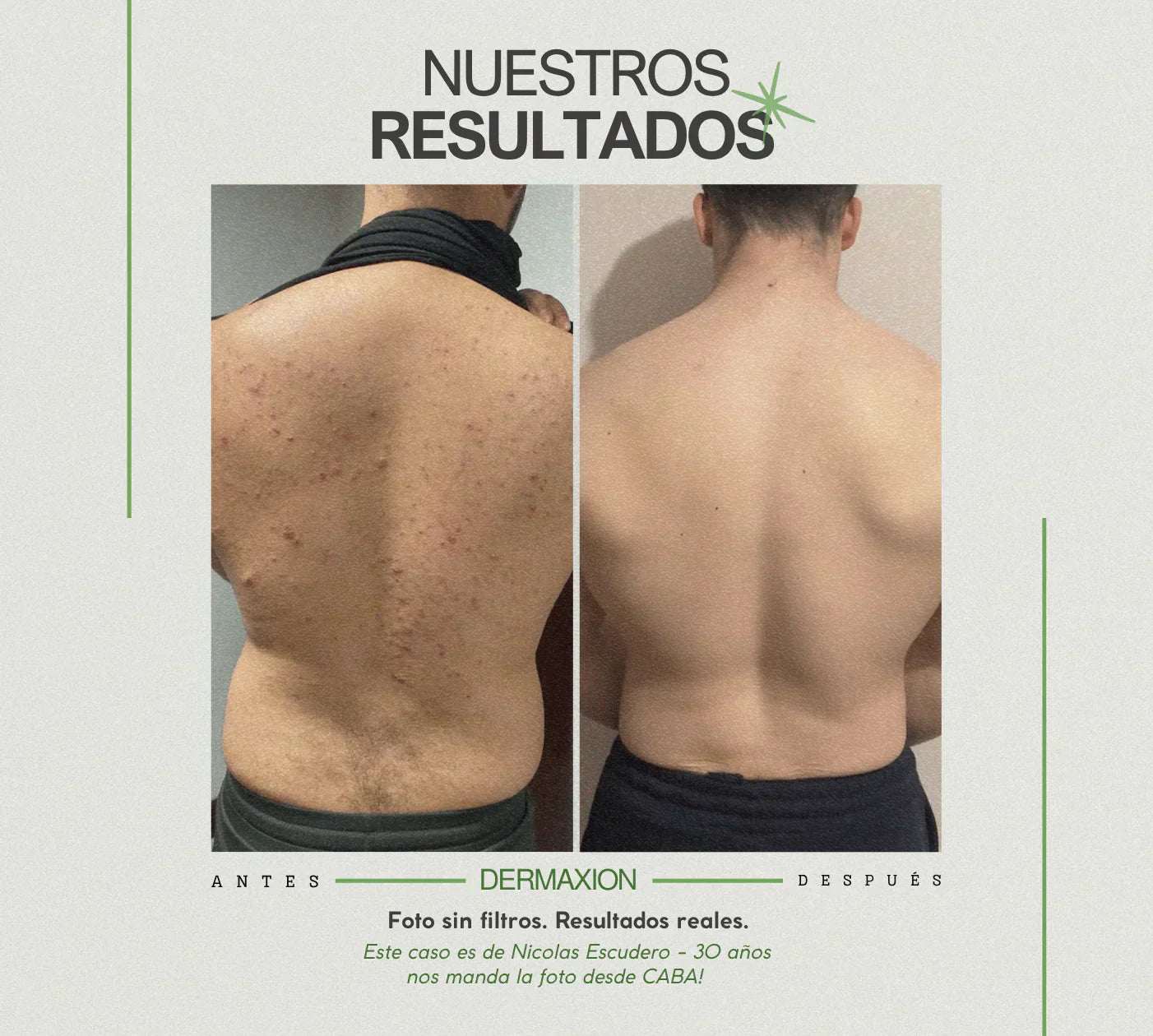 DermaXion® Gel Exfoliante Anti-Acné Pro