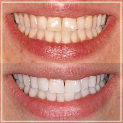 Smile White™ — El Lápiz Blanqueador 4X Más Potente (Promo 2x1)